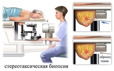 Стереотаксическая биопсия
