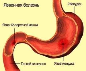 Язвенная болезнь желудка и двенадцатиперстной кишки