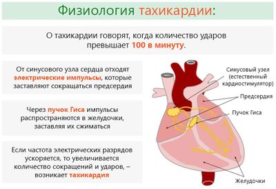 Тахикардия