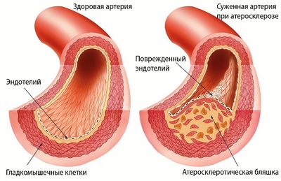Атеросклероз