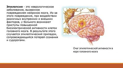 Эпилепсия