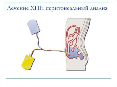 диализ