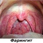 Гнойный фарингит: симптомы, лечение и фото у взрослых