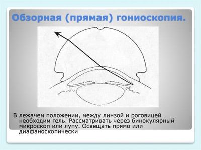 Гониоскопия