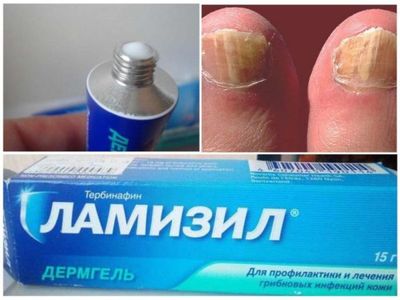 Грибок ногтей на большом пальце ноги: лечение народными средствами и противогрибковыми препаратами5