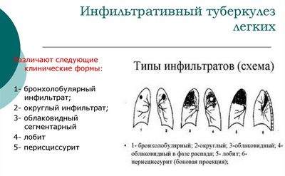 Типы инфильтратов