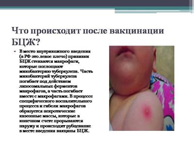 Прививка от туберкулеза