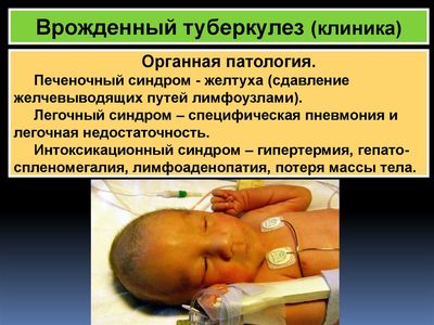 Врожденный туберкулез