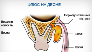 флюс на десне