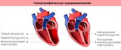 Гипертрофическая КМП