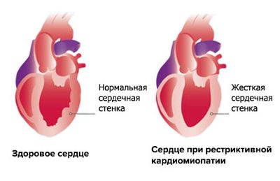 Рестриктивный вид патологии