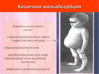Синдром мальабсорбции