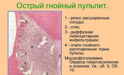 Острый гнойный пульпит