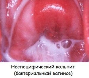 кольпит при беременности