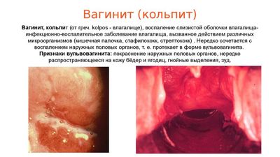 кольпит при беременности