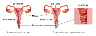 кольпит при беременности