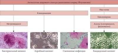 кольпит при беременности