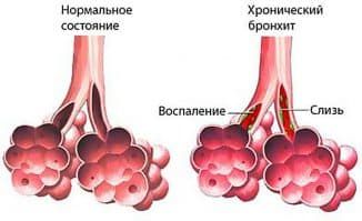 хронический бронхит