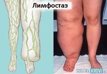 Слоновость