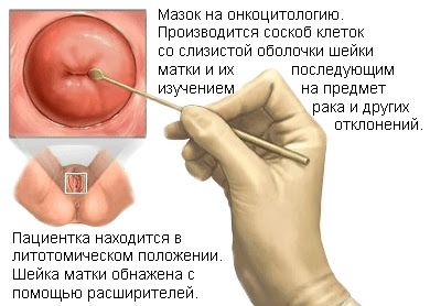 Забор мазка с шейки матки