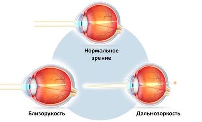 Близорукость и дальнозоркость