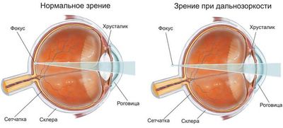 Зрение при дальнозркости