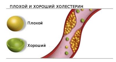 Плохой и хороший холестерин