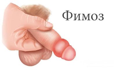 Фимоз - сужение крайней плоти