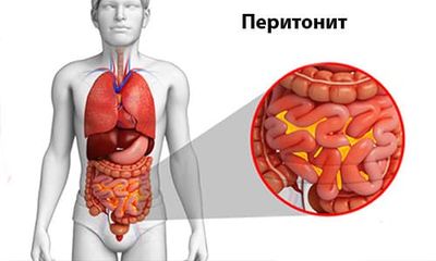 Перитонит