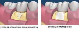 лоскутная операция