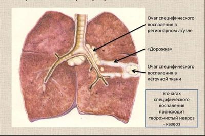 Первичный туберкулезный комплекс