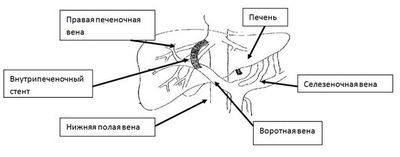 Портосистемное шунтирование