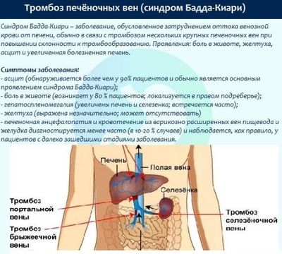 Синдром Бадда-Киари