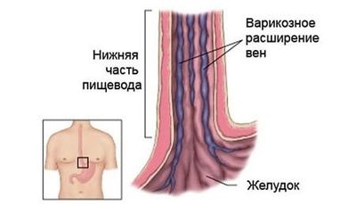 Расширенные вены пищевода