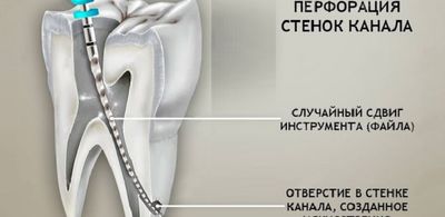 Перфорация корня зуба