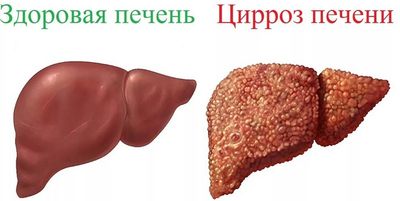 При циррозе печени клетки органа заменяются соединительной тканью.