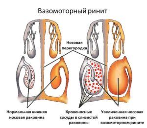 вазомоторный ринит