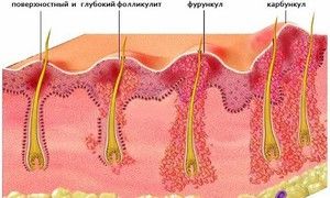 Фурункулез имеет несколько стадий развития.