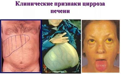 Клинические признаки цирроза печени