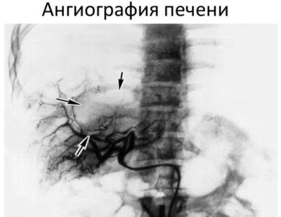 Ангиография
