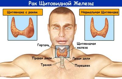клиническая картина рака щитовидной железы