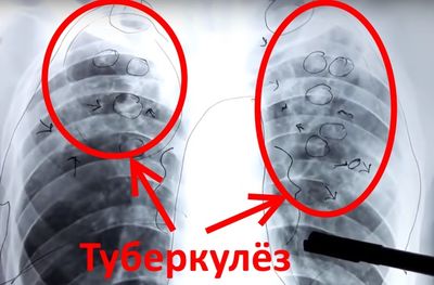 Пример туберкулёза на рентген снимке грудной клетки