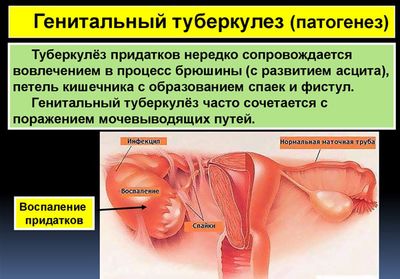 Генитальный ТБ