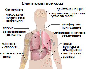 Симптомы лейкоза