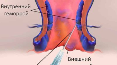 Что такое склеротерапия геморроидальных узлов и кому она показана