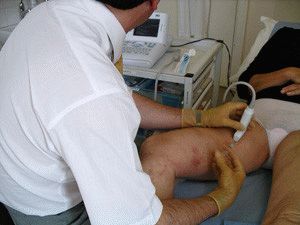 Пенная склеротерапия