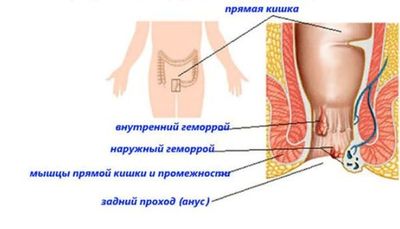 виды геморроя
