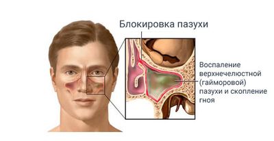 Может ли быть гайморит без насморка, температуры и заложенности носа?