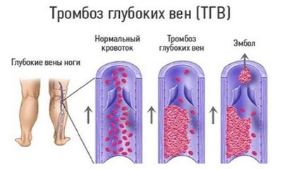 тромбоз