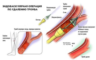 удаление тромба